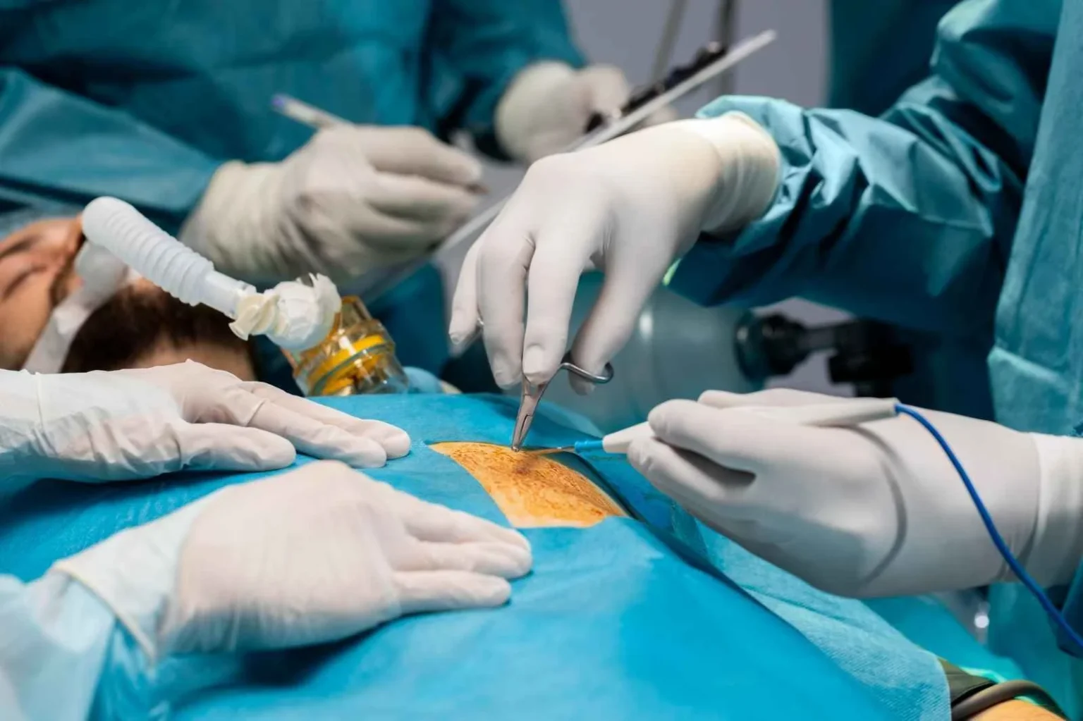 laproscopy-surgery in aundh - vitalife hospital