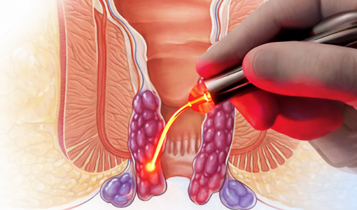 Piles, Fissure & Fistula Hospital Wakad